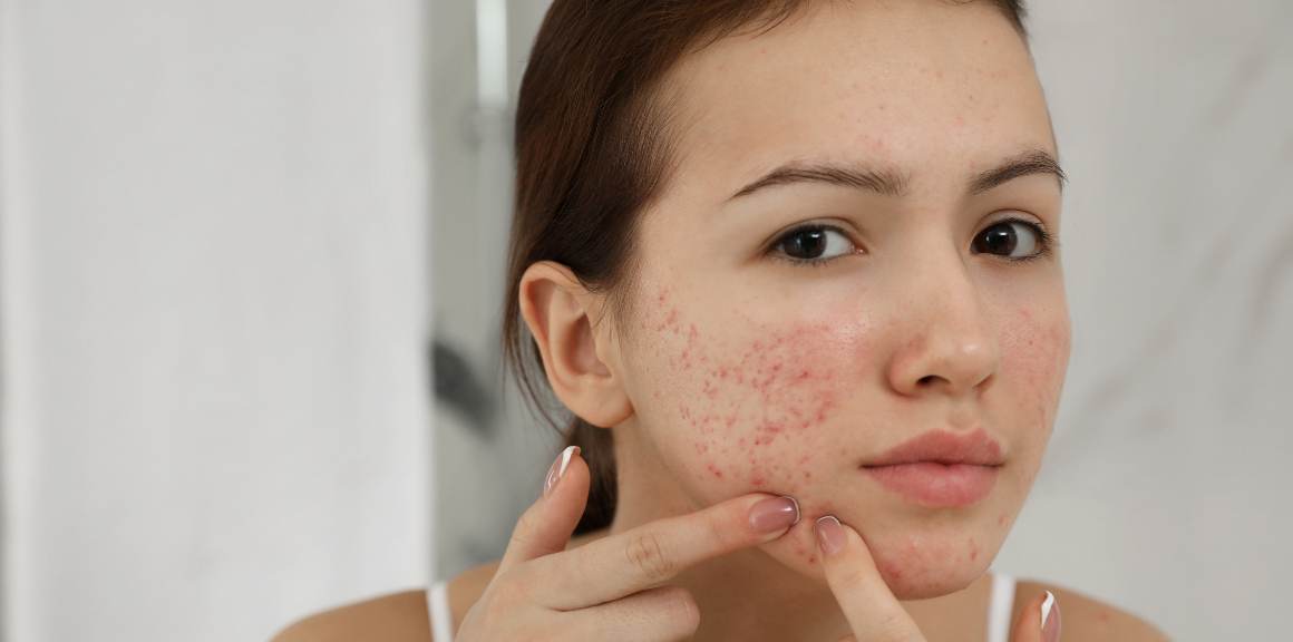 what-hormone-causes-acne-in-females